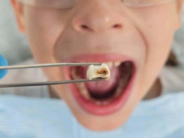 Best Emergency Dental Extractions in Meadow Woods, FL